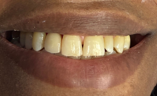 After Dental Implants