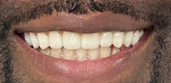 After Dental Implants