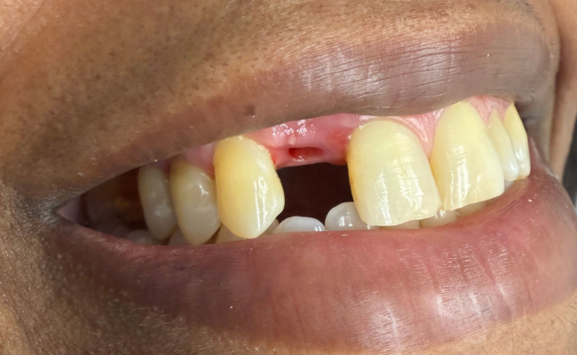 Before Dental Implants