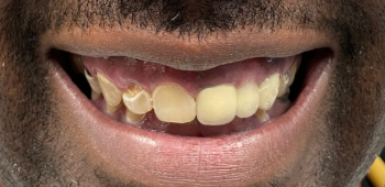 Before Dental Implants