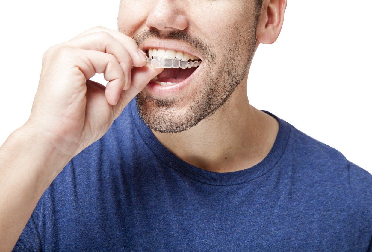 Man inserting Invisalign teeth