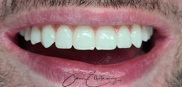 After Dental Implants