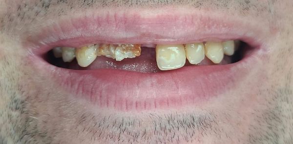 Before Dental Implants