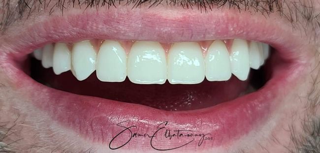 Después Rehabilitación bucal completa