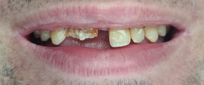 Antes Rehabilitación bucal completa