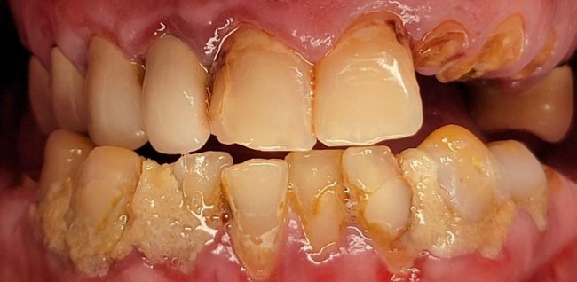 Antes Rehabilitación bucal completa