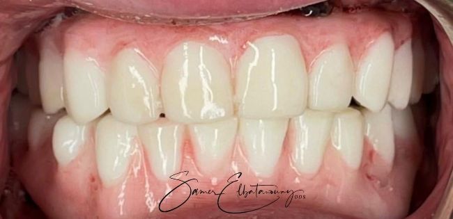 Después Rehabilitación bucal completa