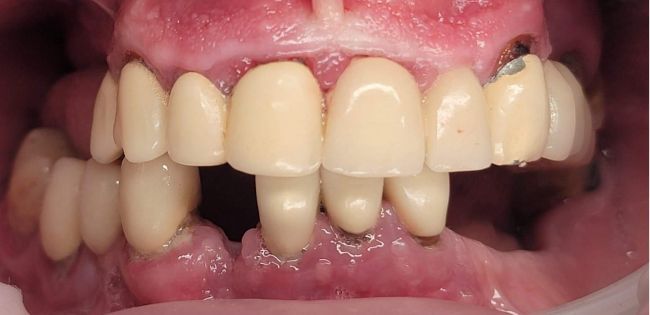 Antes Carillas dentales