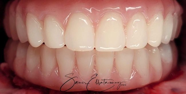 Después Carillas dentales