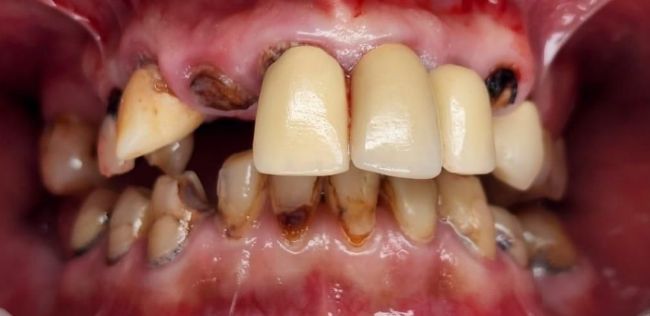 Antes Rehabilitación bucal completa