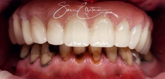 Después Rehabilitación bucal completa