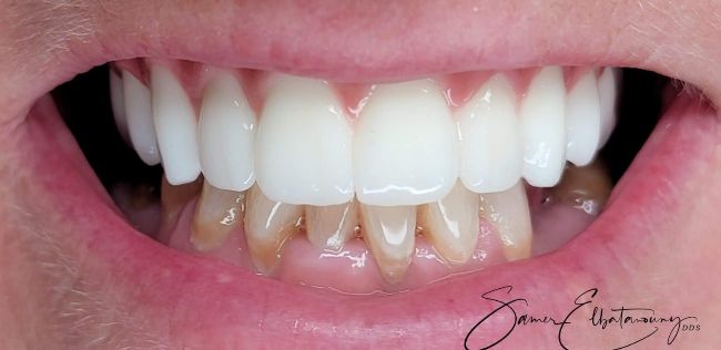 After Dental Implants