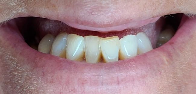 Before Dental Implants