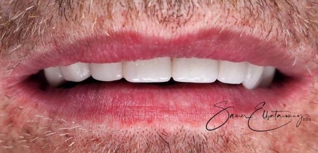 Después Carillas dentales