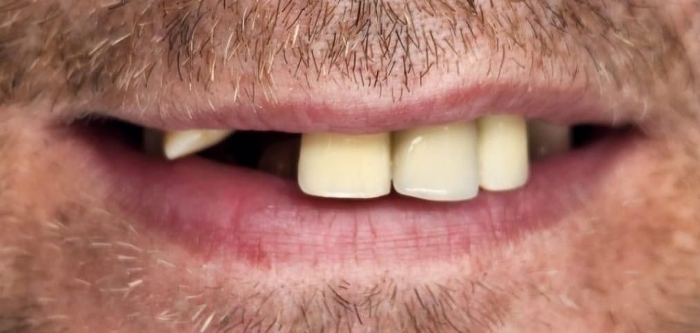 Antes Carillas dentales