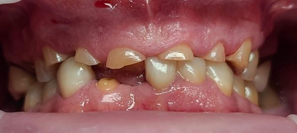 Antes Rehabilitación bucal completa