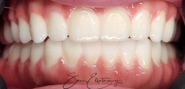 Después Rehabilitación bucal completa