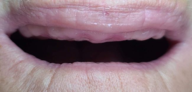 Before Dental Implants