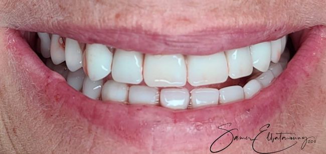 After Dental Implants