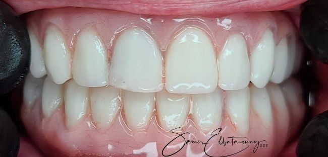 Después Contorno de las encías