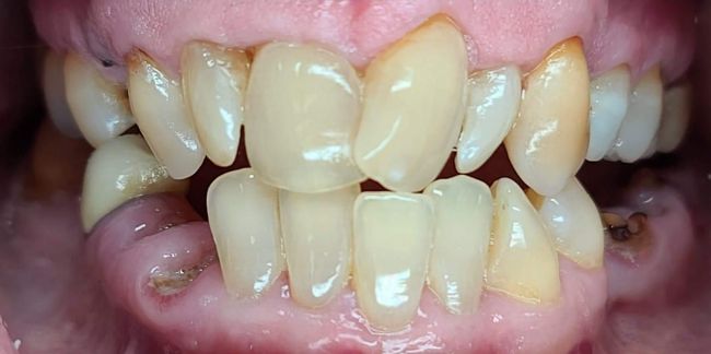 Antes Contorno de las encías