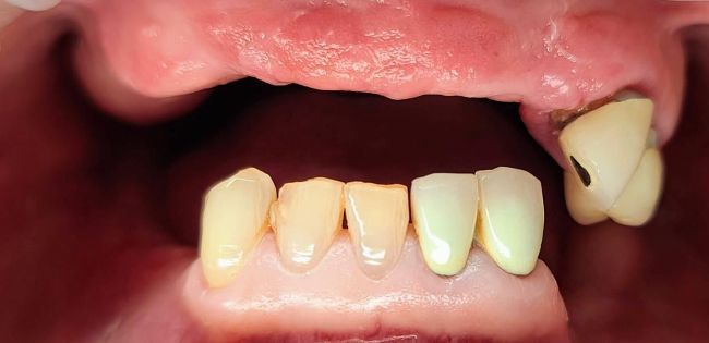 Antes Rehabilitación bucal completa