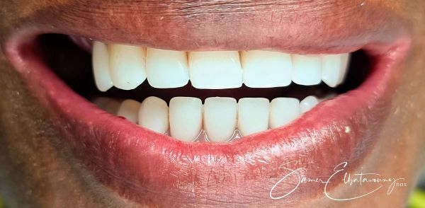 After Dental Implants