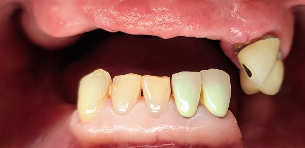 Before Dental Implants