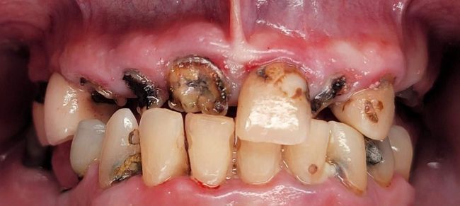 Antes Rehabilitación bucal completa