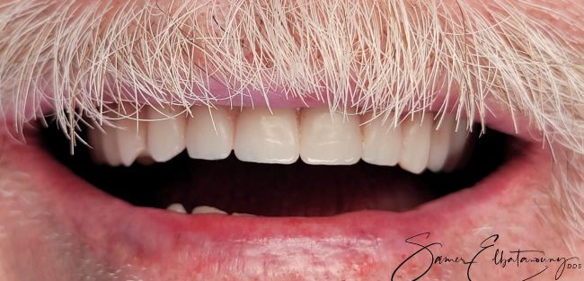 Después Rehabilitación bucal completa