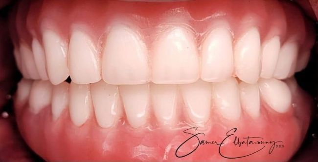 Después Rehabilitación bucal completa