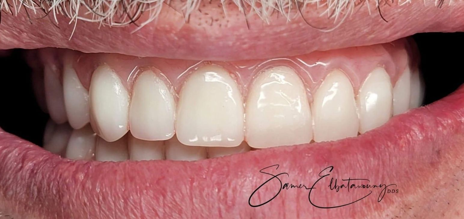 Después Contorno de las encías