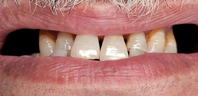 Antes Contorno de las encías