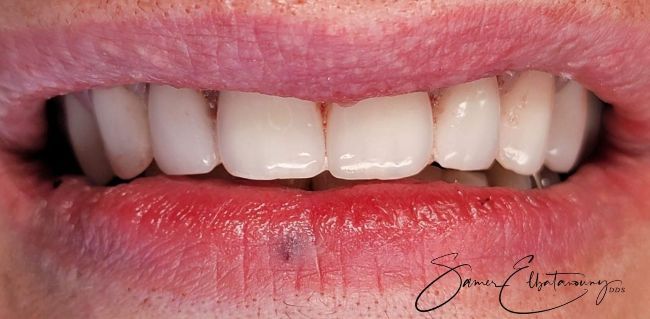 Después Unión compuesta