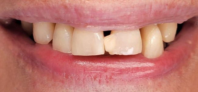 Antes Unión compuesta