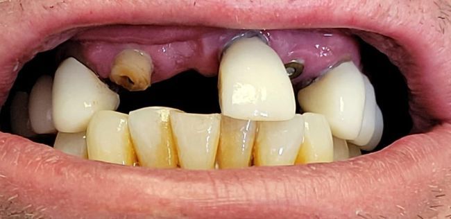 Before Dental Implants