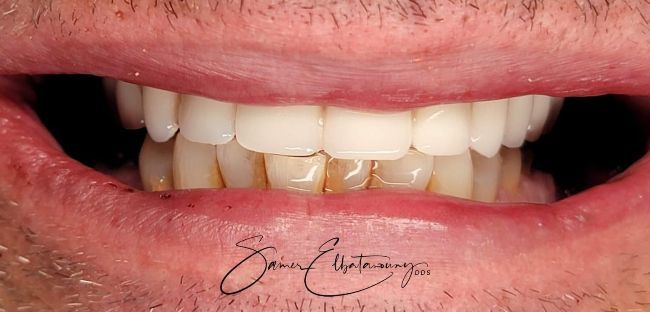 After Dental Implants