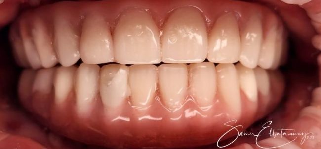 After Dental Implants