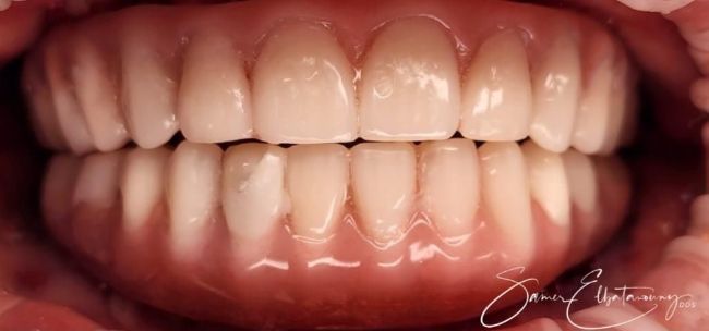 Después Rehabilitación bucal completa