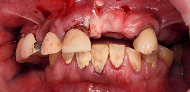 Before Dental Implants