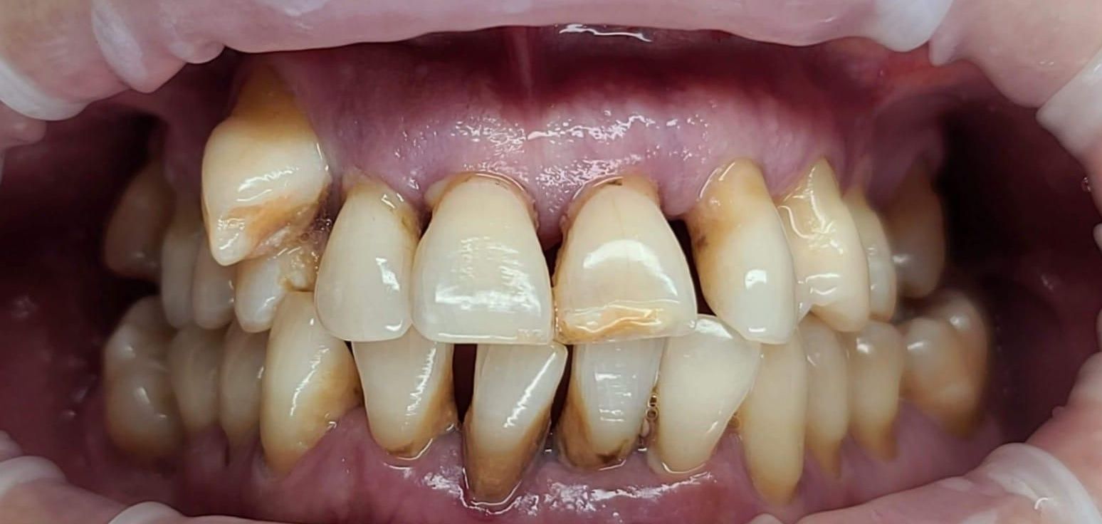 Before Rehabilitación bucal completa