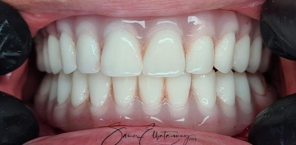 Después Rehabilitación bucal completa