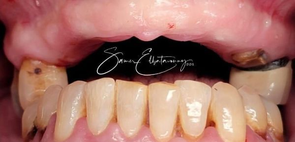 Before Dental Implants