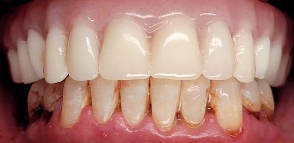 After Dental Implants