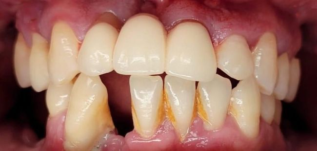 Antes Unión compuesta