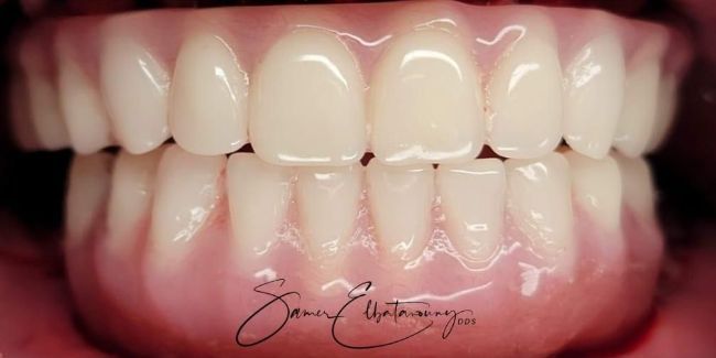 Después Unión compuesta