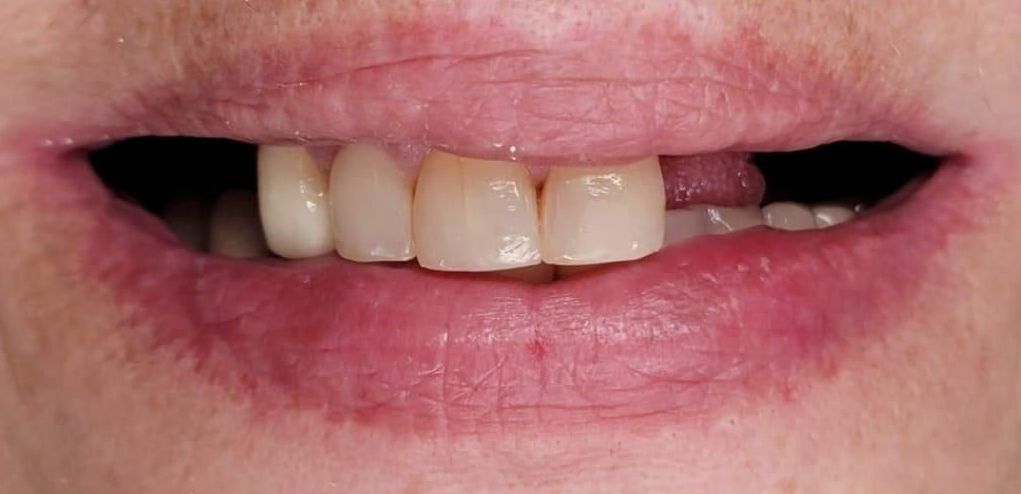 Before Dental Implants