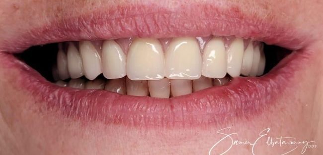 After Dental Implants