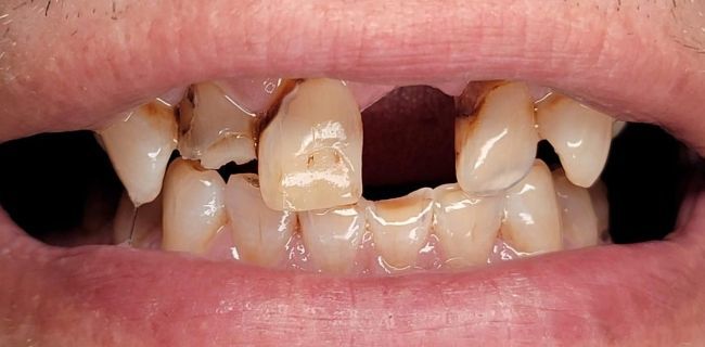 Antes Rehabilitación bucal completa