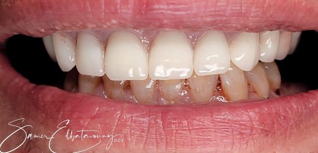 Después Rehabilitación bucal completa